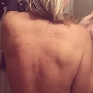 Light cupping therapy marks