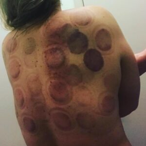 dark cupping therapy marks