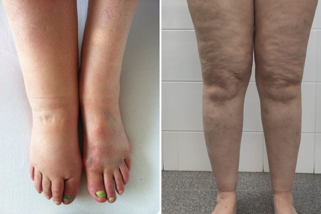 lymphedema vs. lipedema