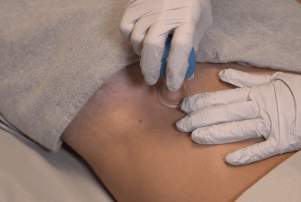 scar massage post-surgery