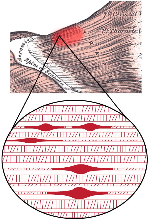 trigger point example